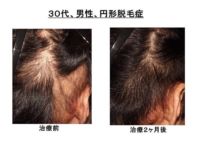 円形脱毛症　病院""